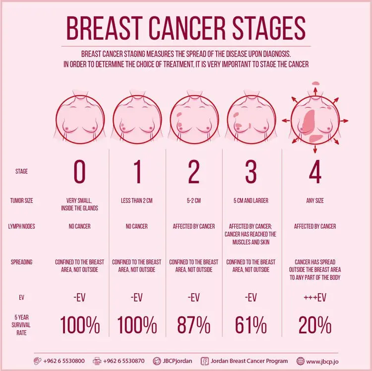 Breast cancer: symptoms, stages, treatment