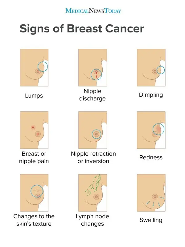 Breast cancer