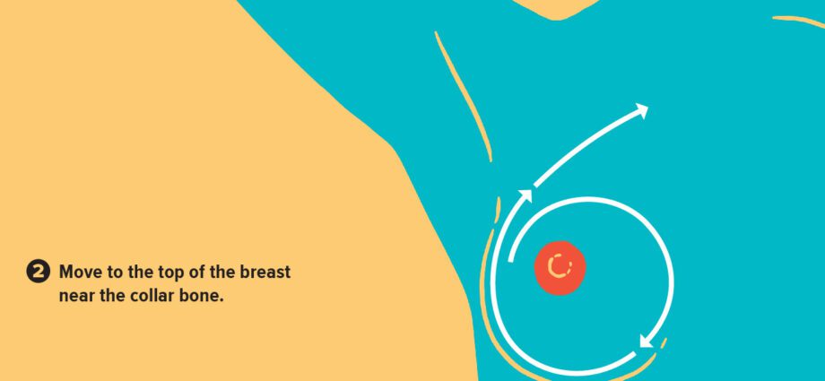 Breast cyst &#8211; Our doctor&#8217;s opinion