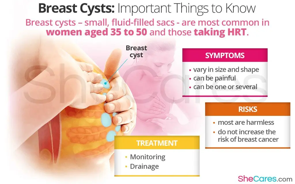 Breast Cyst &#8211; Sites of Interest