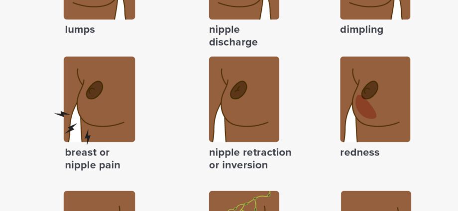 Breast examination: signs of normal