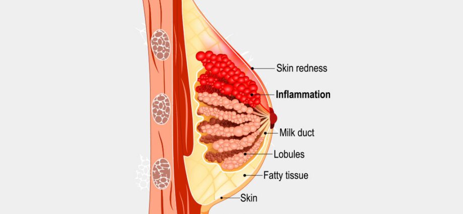 Breast hurts while feeding: what to do? Video