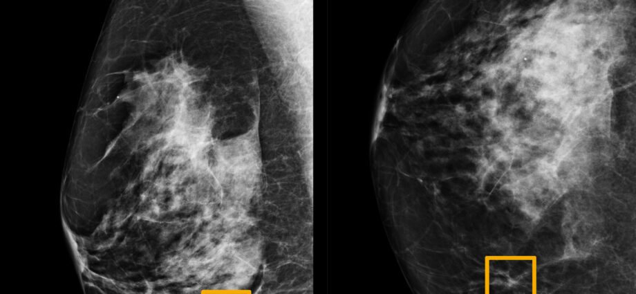 Breast Cancer: Breast Mammography