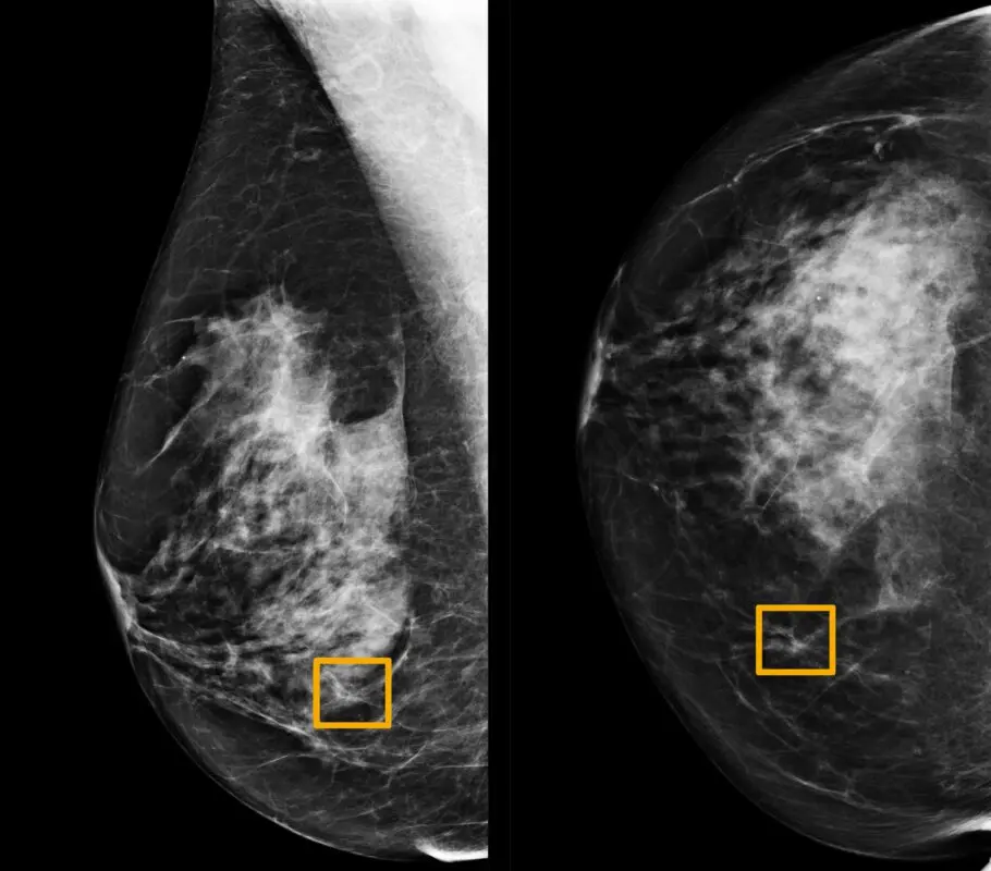 Breast mammogram