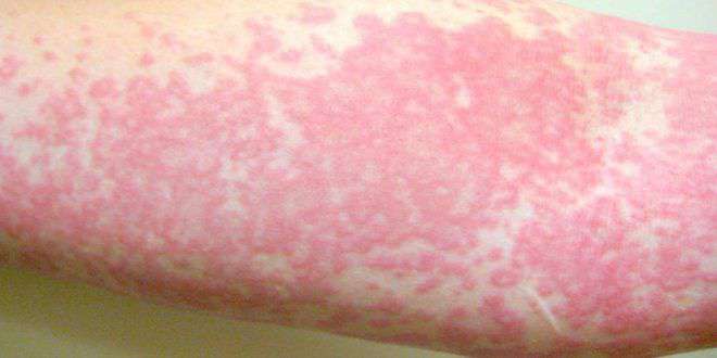 Brom allergiyası: simptom və müalicə