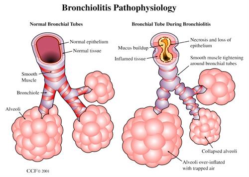 Бронхиолитис
