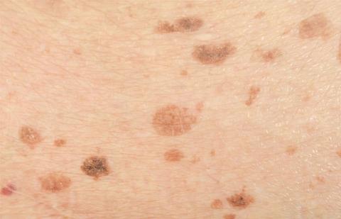 Brown spots on the skin: what to do? Video