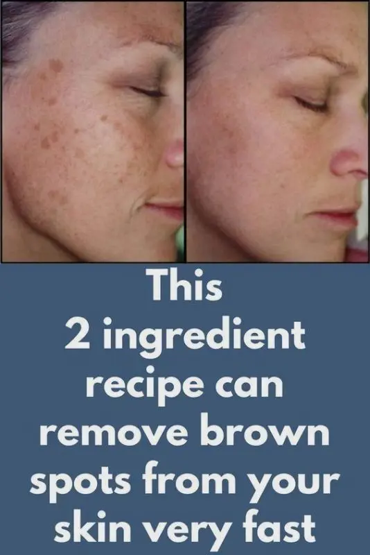 Brown spots: what are the most effective active ingredients to get rid of them?