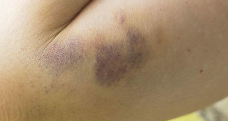 Bruise from a blow: how to get rid of