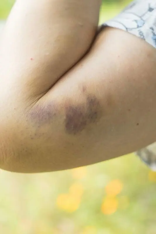 Bruise from a blow: how to get rid of