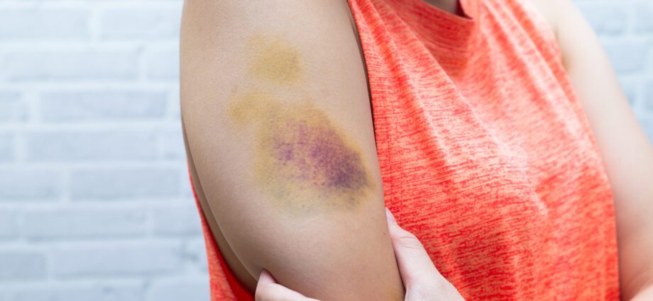 Bruises and bruises