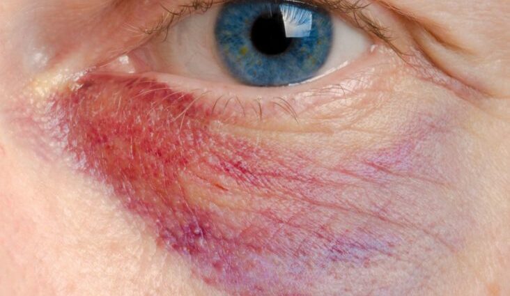 Bruises under the eyes: causes and treatment. Video