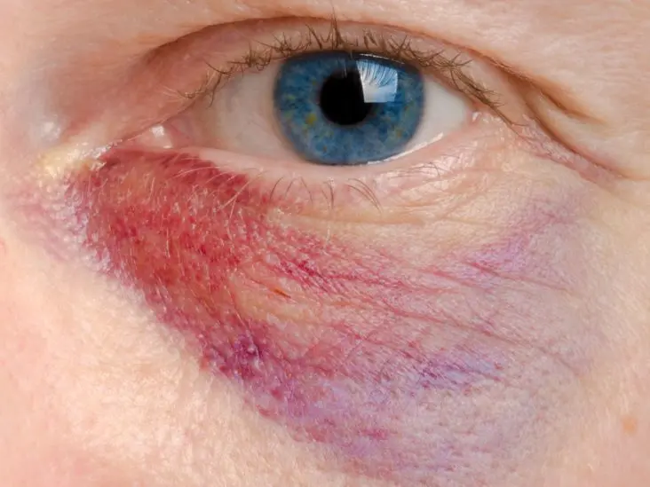 Bruises under the eyes: causes and treatment. Video