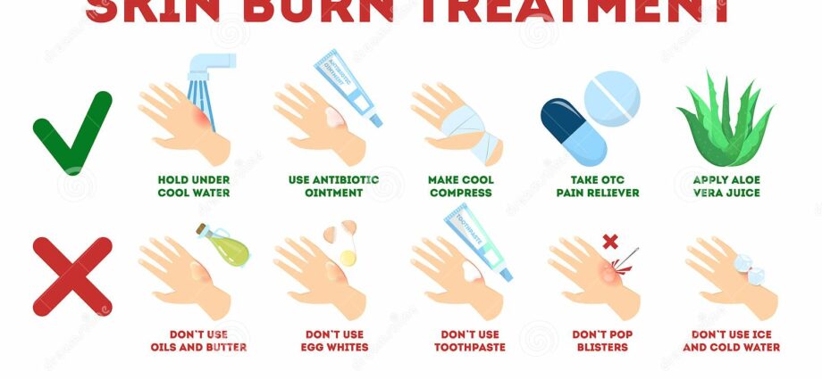 Burns: the first aid to be given