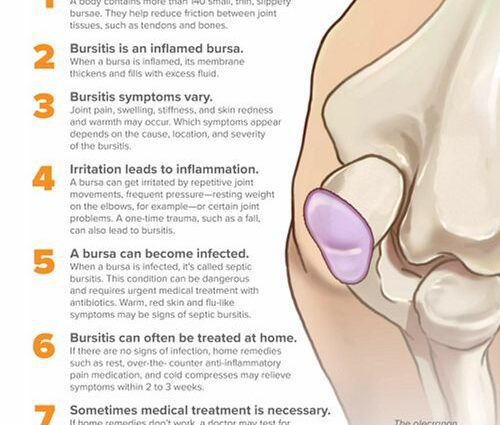 Bursitis - oorzaken, symptomen, behandelingen