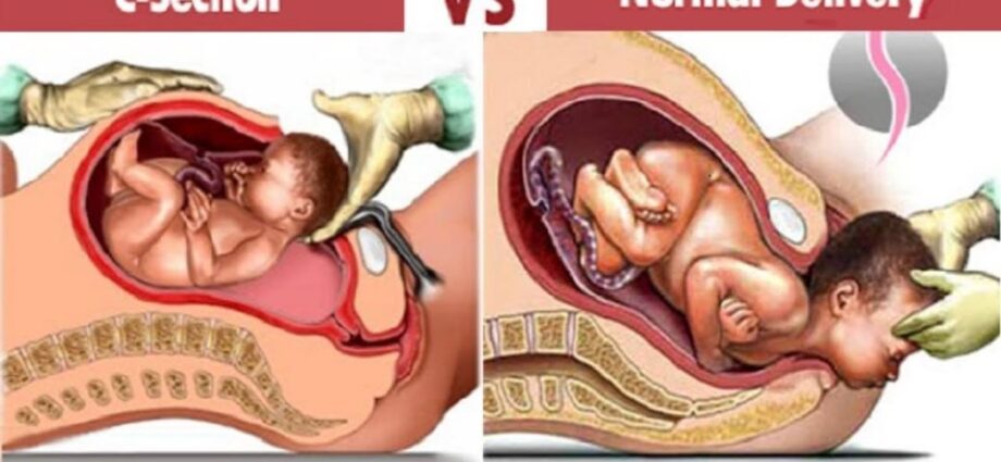 Caesarean section and vaginal delivery