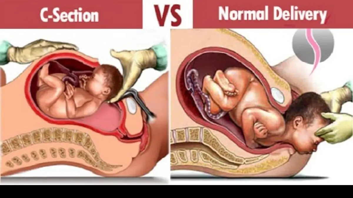 Caesarean section and vaginal delivery