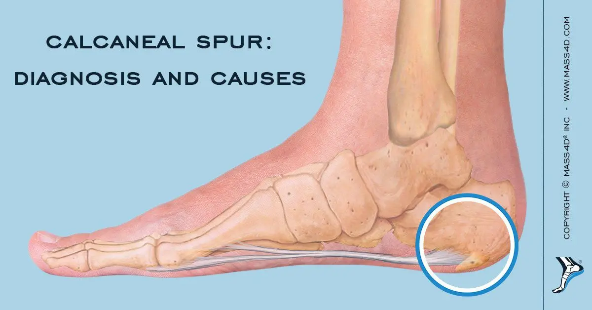 Calcaneal enthesophyte: symptoms and treatments