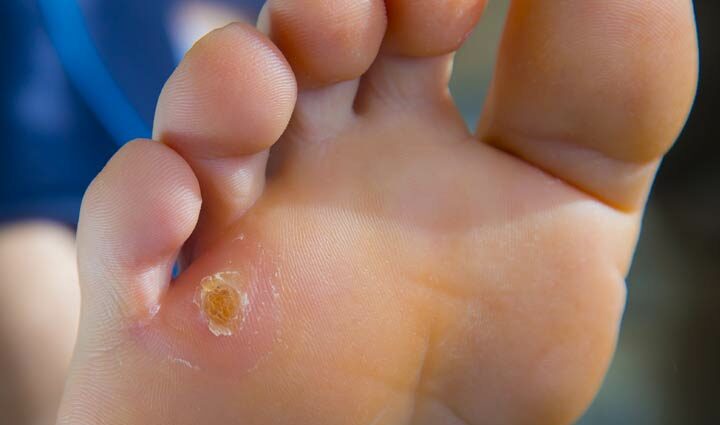 Calluses on the toes: how to beat the problem. Video