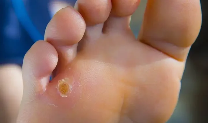 Calluses on the toes: how to beat the problem. Video