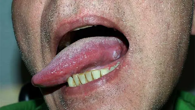 Cancer of the tongue