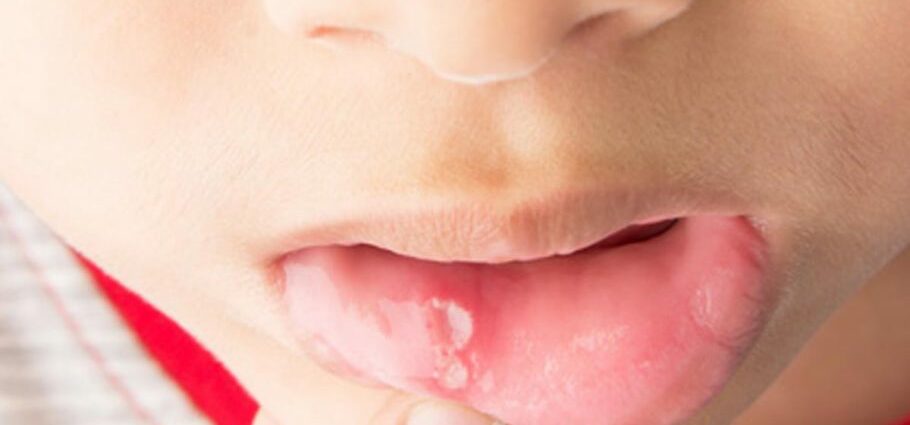 어린이의 구내염 : 치료 방법?