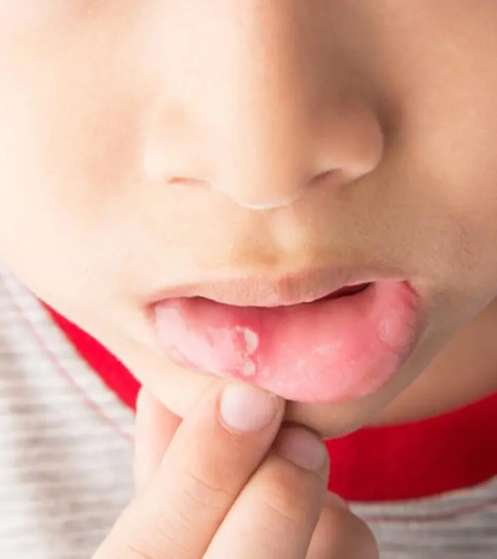 Canker sores in children: how to treat them?