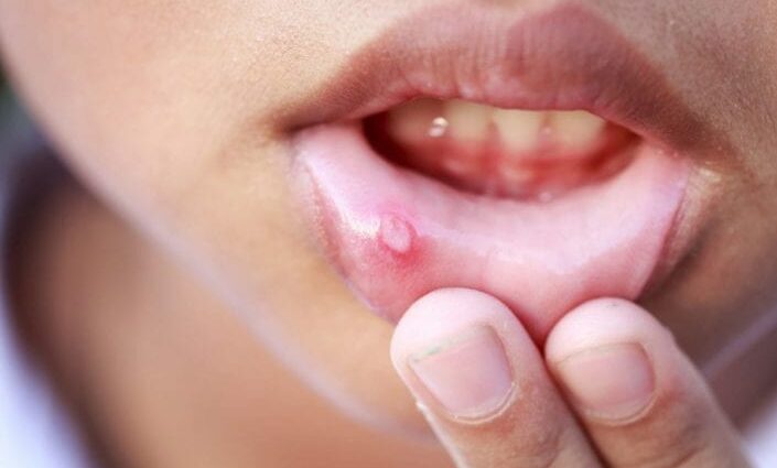 Canker sores &#8211; Our doctor&#8217;s opinion