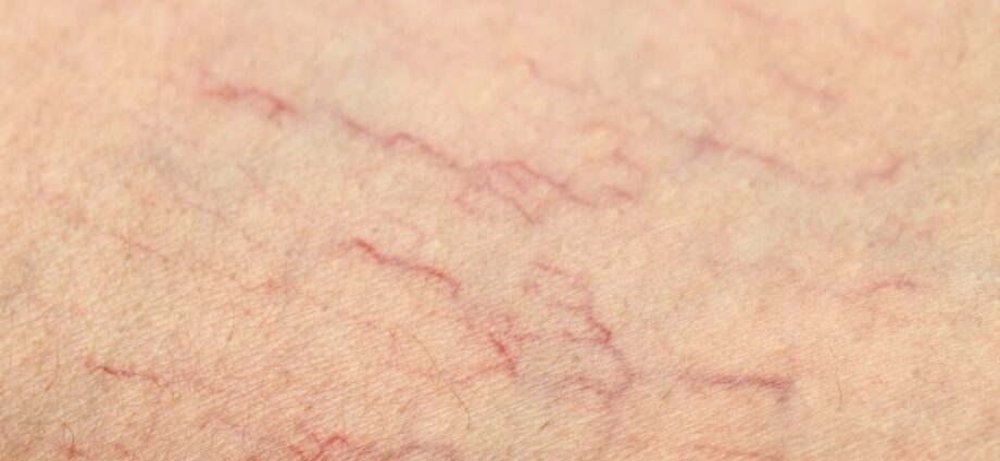 Capillaries on the legs: causes of appearance. Video