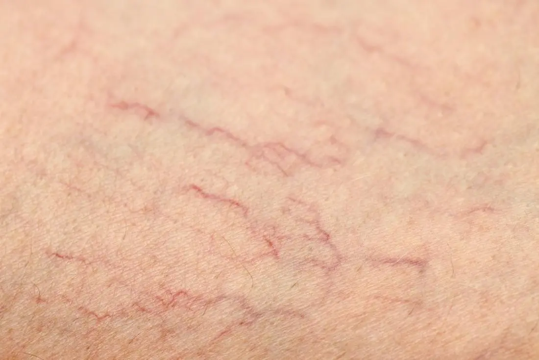 Capillaries on the legs: causes of appearance. Video