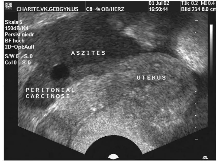 Carcinose peritoneal