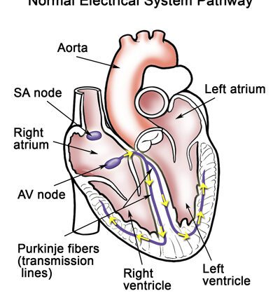 Cardiac arrhythmia in children: causes