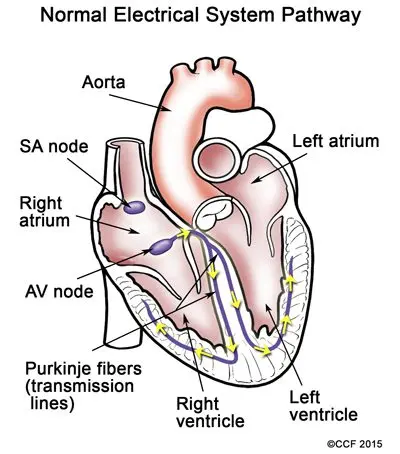 Cardiac arrhythmia in children: causes