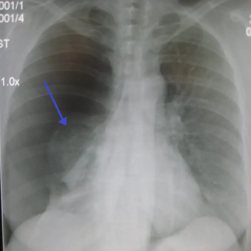 Cardiovascular or pulmonary collapse: definition