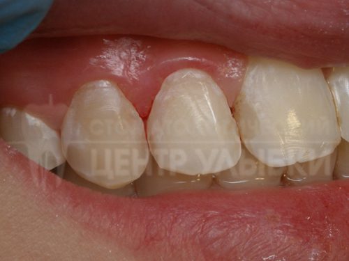 Caries treatment without drilling. Myth or Reality?