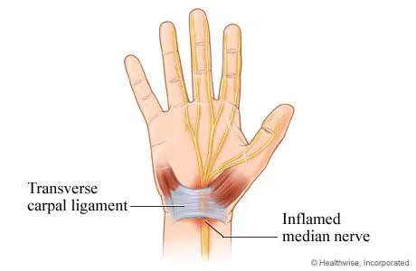 Carpal tunnel syndrome &#8211; Our doctor&#8217;s opinion