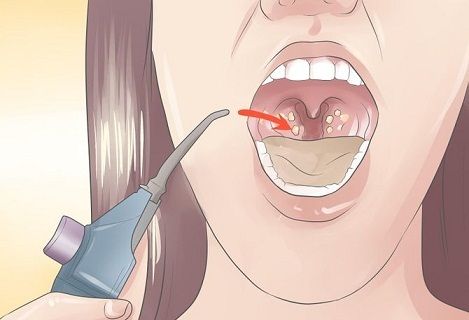 Caseum: kedu njikọ na tonsils?