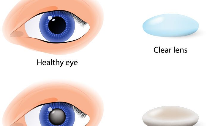 Cataract prevention