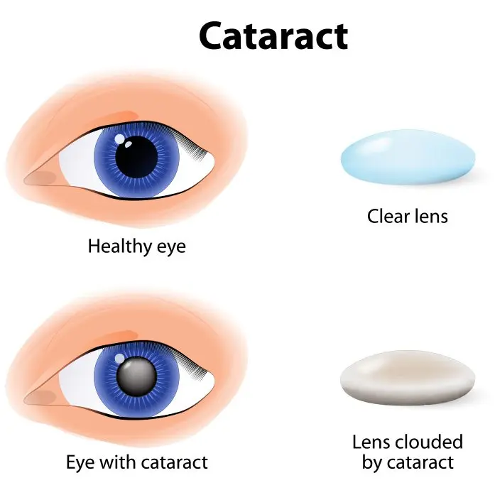 Cataract prevention