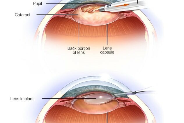 မျက်စိအတွင်းတိမ်ခွဲစိတ်ကုသမှု