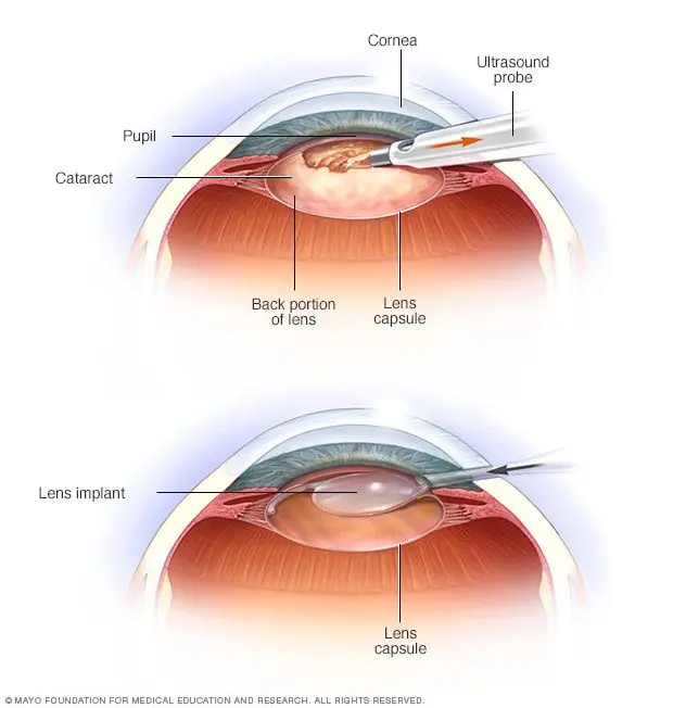 Cataract surgery