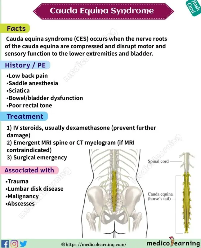 Cauda equina syndrome