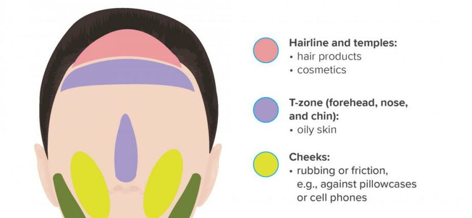 The causes of acne on the face. Video