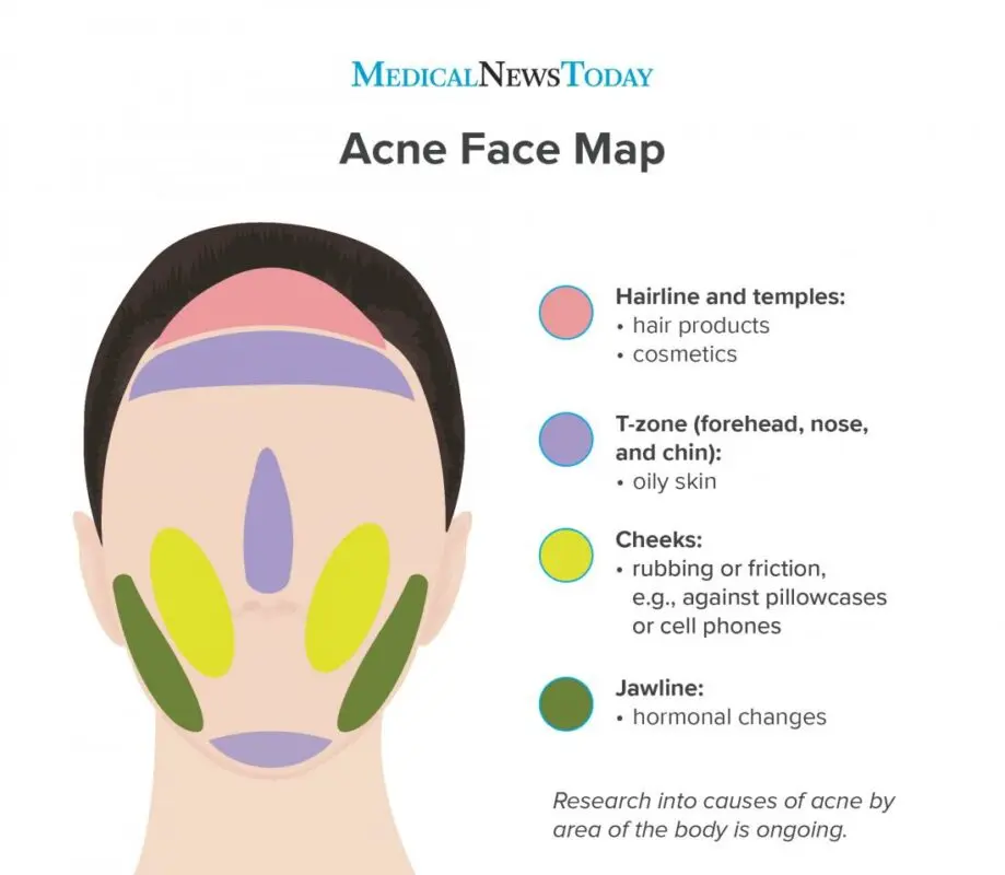 Causes of the appearance of acne on the face Video