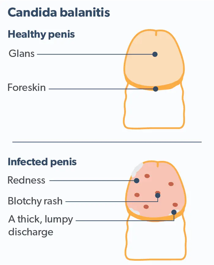 Causes of balanitis