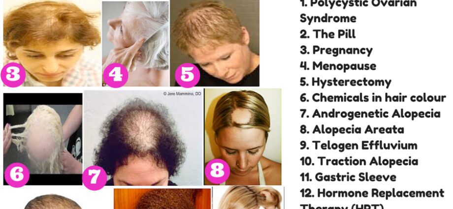 Causes of hair loss in girls and women