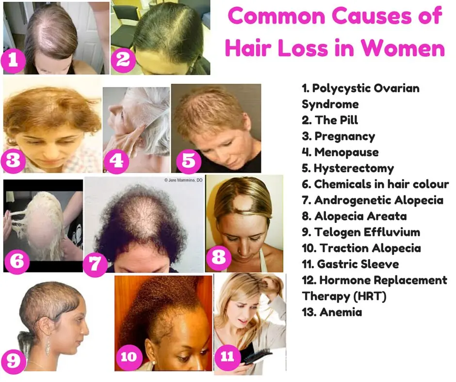 Causes of hair loss in girls and women