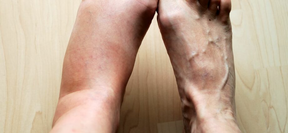 Causes of leg swelling: how to get rid of swelling? Video