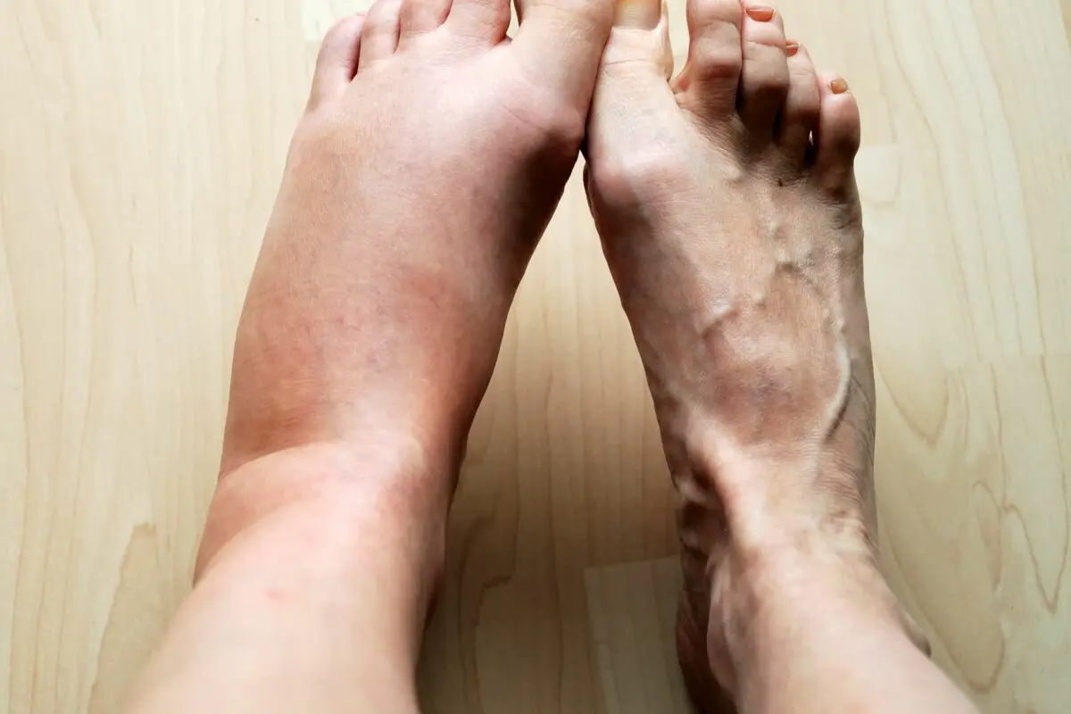 Causes of leg swelling: how to get rid of swelling? Video