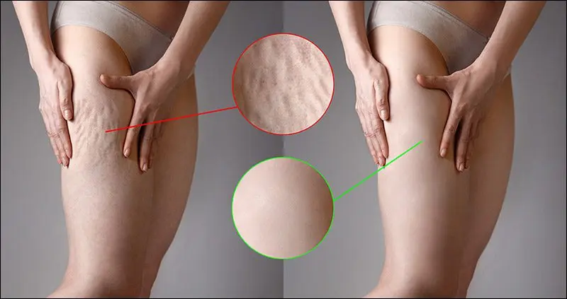 Cellulite how to get rid of anti-cellulite wraps